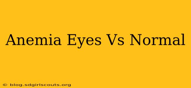 Anemia Eyes Vs Normal