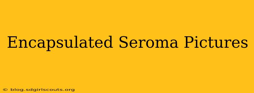 Encapsulated Seroma Pictures