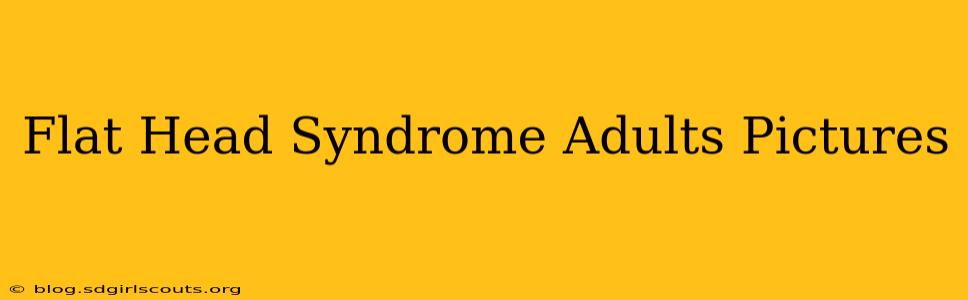 Flat Head Syndrome Adults Pictures