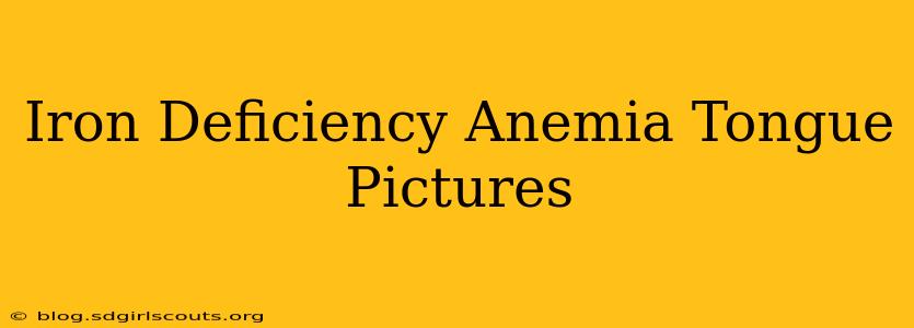 Iron Deficiency Anemia Tongue Pictures