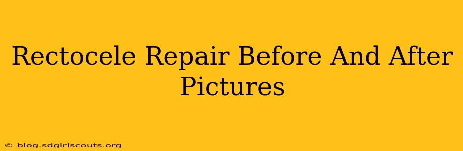 Rectocele Repair Before And After Pictures