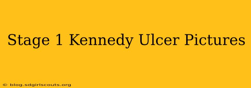 Stage 1 Kennedy Ulcer Pictures