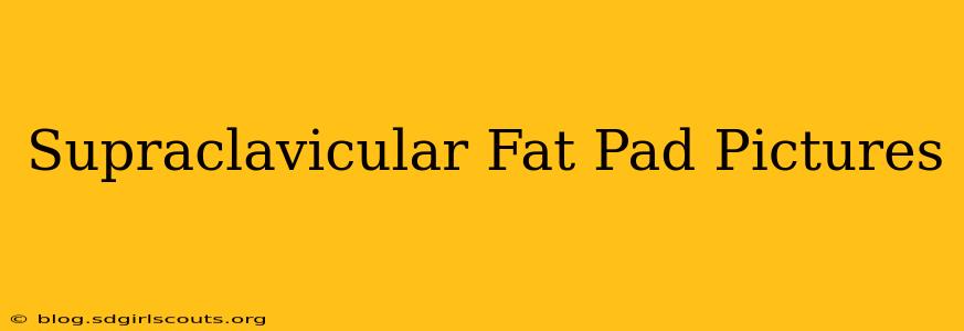 Supraclavicular Fat Pad Pictures