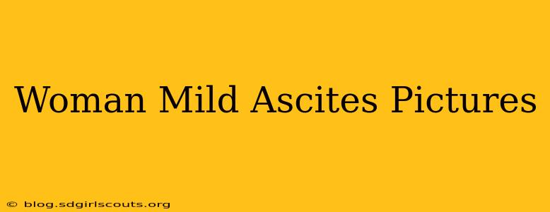 Woman Mild Ascites Pictures